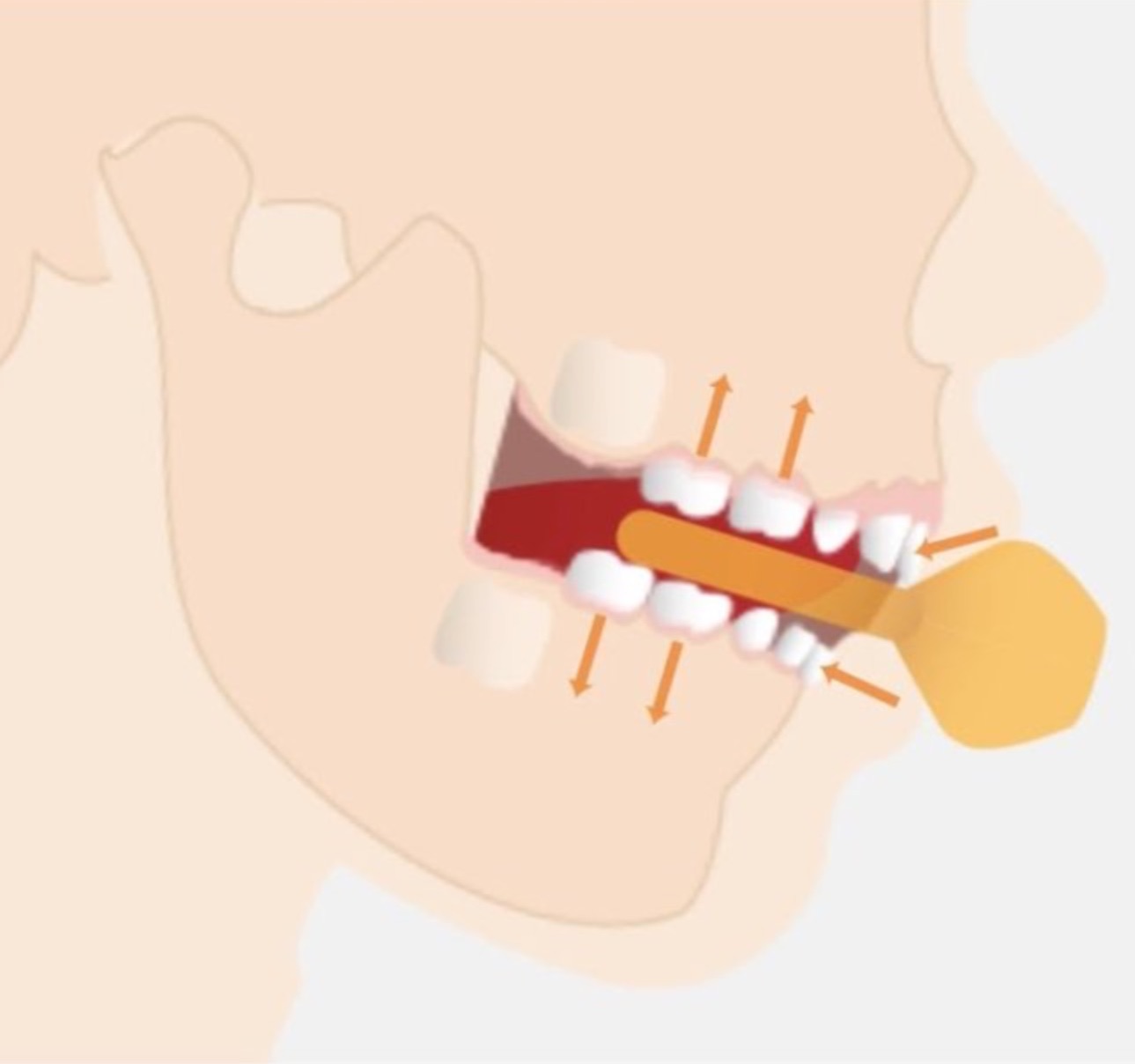 Placement Machouyou dans la bouche